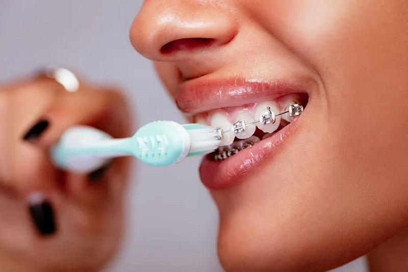 Hướng dẫn các bước vệ sinh răng miệng khi niềng